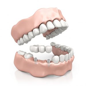 implntologie-dentaire-techniques-couronne_sur_implant-lachat-grenoble