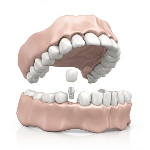 implntologie-dentaire-techniques-implant_seul-lachat-grenoble