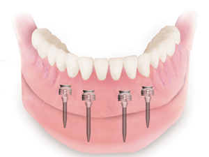 mini-implants-dentiste-lachat-grenoble